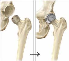 Arthritis, is the wearing away of the protective covering on the bone ends (cartilage). In severe cases the cartilage is worn away completely and the bone underneath also starts to wear away.
