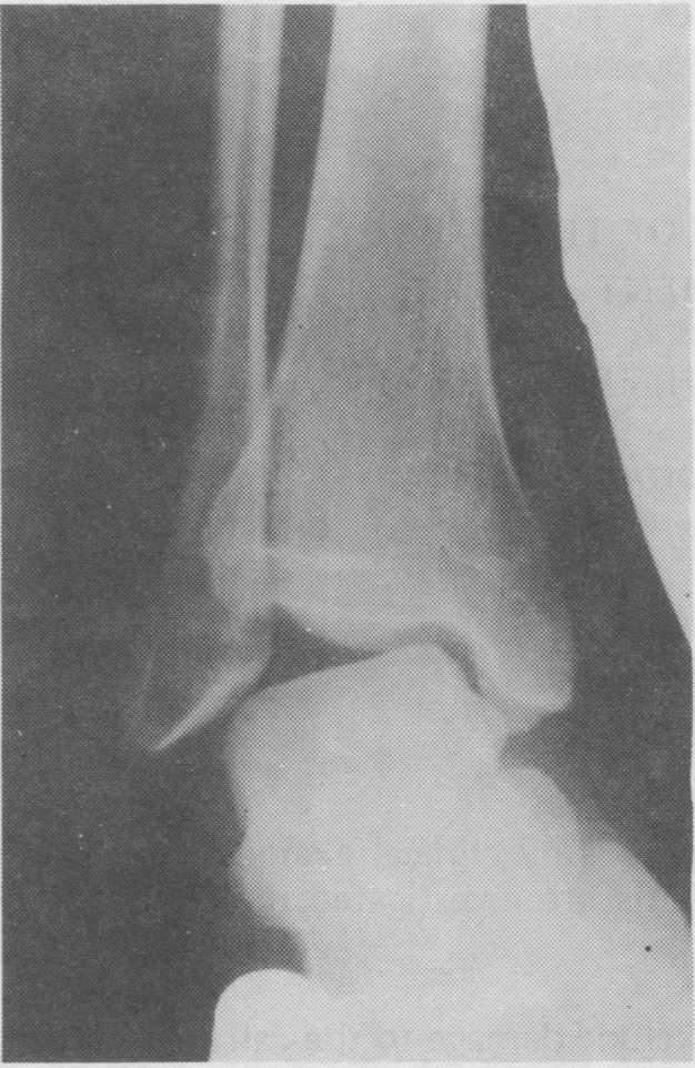 246 Fig. 2: Stress X-ray of ankle showing varus instability fright ankle). -._ Fig.