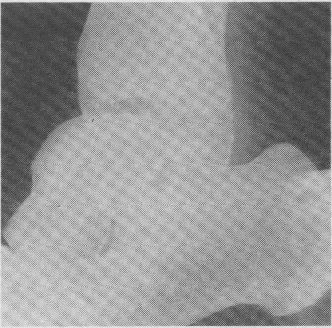 4: Stress X-ray of ankle revealing anterior instability (right ankle). Fig.