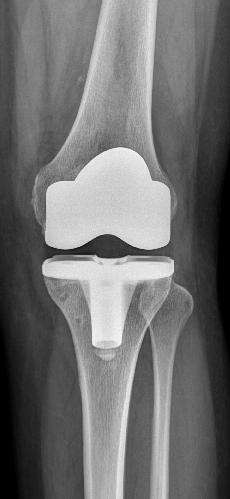 the knee postoperatively.
