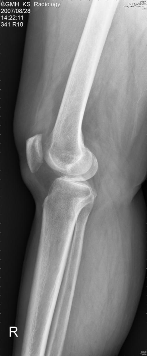 Inclusion Criteria 1. Clinical criteria Pain and tenderness localized to medial joint line. Knee flexion more than 90. Fixed knee flexion deformity less than 10. 2.