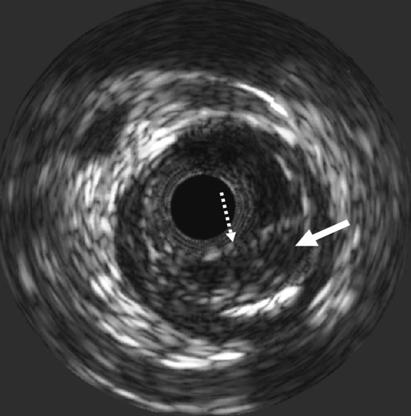 acute coronary events. 11) Intravascular ultrasound (IVUS) is a valuable adjunct to angiography, and this US modality provides new insights on the diagnosis and therapy for coronary disease.