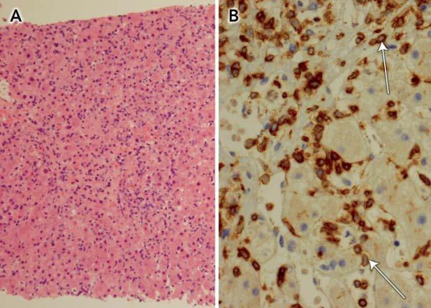 Hepatosplenic T- cell lymphoma occurrences Estimated Risks: Males <35 yrs on Thiopurines: 1/7404 Males <35 yrs on Thiopurines + Anti-TNF: 1/3534 Kotlyar et al, Clin Gastroenterol Hepatol.