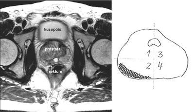 Joonis 2. Aksiaalse T2-kaalutud MRT kujutise kõrvutamine vähikaardiga. Patsient 1. Hüpointensiivne ala, kartsinoom ( ), pole levinud kapslist väljapoole.