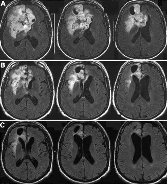 - Slow and progressive response to TMZ of a patient with a low-grade oligodendroglioma
