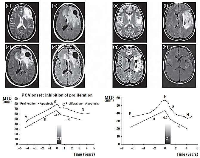 PCV chemotherapy for LGGs - commonly a prolonged (>2 years) and ongoing response after chemotherapy termination in dynamic volumetric