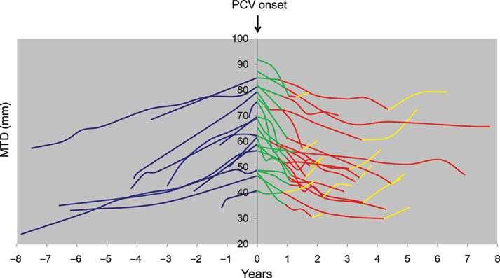 - Evolution of the mean tumor diameter (MTD) before, during, and after PCV chemotherapy Peyre M, et al.