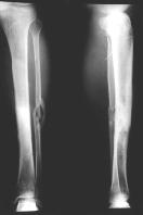 reduction and internal fixation with plate and screws FigA Plain film at 3 months after operation shows local osteolytic change and pretibial sequestrum,