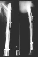 407 Fig 2 A 39 year-old male who sustained open, comminuted fracture of proximal shaft of femur underwent