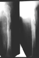 C Plain film shows bony consolidation at 9 months after sequestrectomy, external fixation, antibiotic cement beads