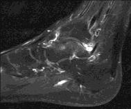 Rheum Dis 2013 Magnetic resonance imaging Synovitis Tophus Erosions Joint space narrowing Bone marrow edema