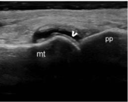 55 McQueen Ann Rheum Dis 2012 US: cartilage, bone and tendon involvement Hyperechoic aggregates in patellar tendon Double contour sign in MTP1 DECT: