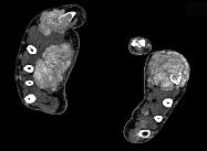 associated with both erosion and tophus Axial CT images of the hands showing tophus closely associated with