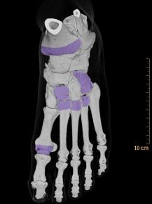Conventional CT: monitoring erosion DECT: monitoring disease CT erosion score Feasible (7 bones/foot) High inter-observer reliability (ICC 0.