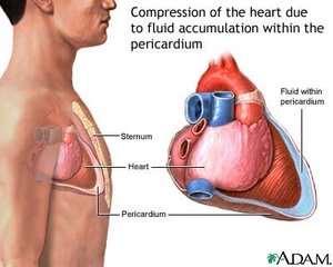 Complicații Pneumotorace Puncție miocardică Puncție coronariană