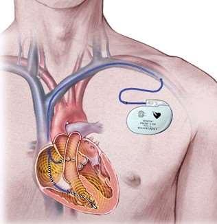 Stimularea electrică a cordului Pacemaker Temporar permanent Extern