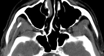 Pterygopalatine Fossa Pterygopalatine Fossa Space between posterior margin of maxillary sinus and