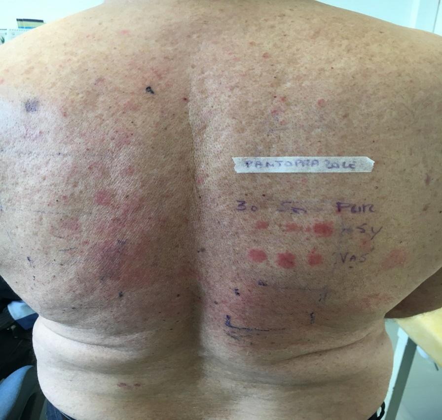 Figure 3: Shows positive patch test to pantoprazole Many studies suggest that Patch tests may be a useful, safe and valuable procedure to demonstrate evidence of drug imputability in CADR.