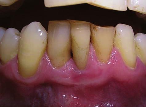 The cases selected in this case series underwent phase I therapy and were on homecare protocol, but on follow-up showed persistent gingival inflammation in the affected sites (sulcus bleeding score