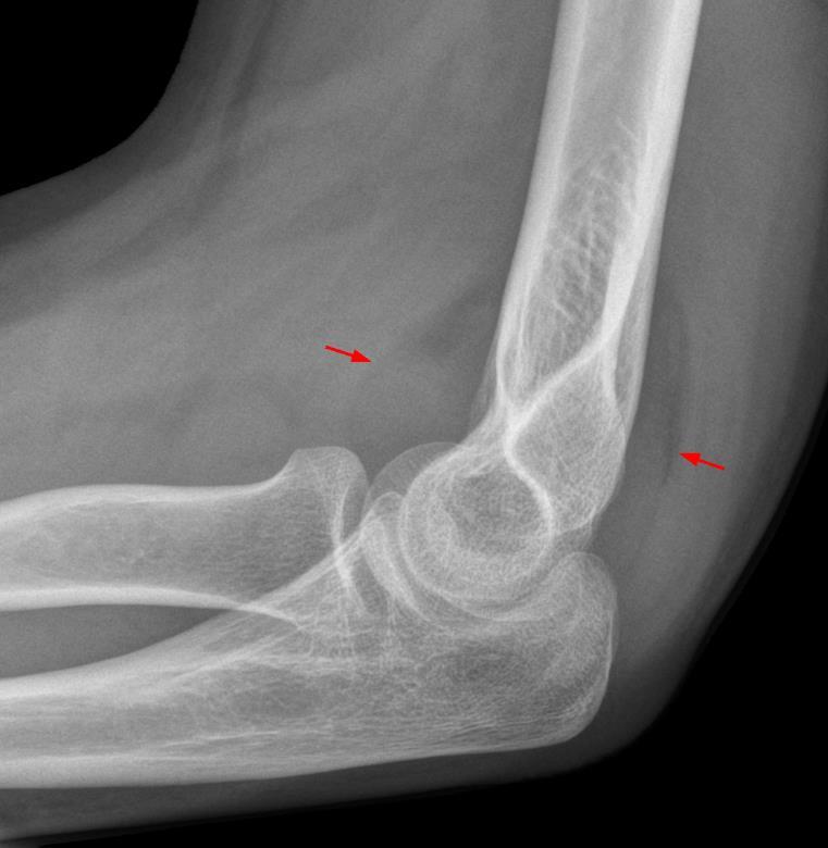 Thrower s elbow Imaging Why X rays?
