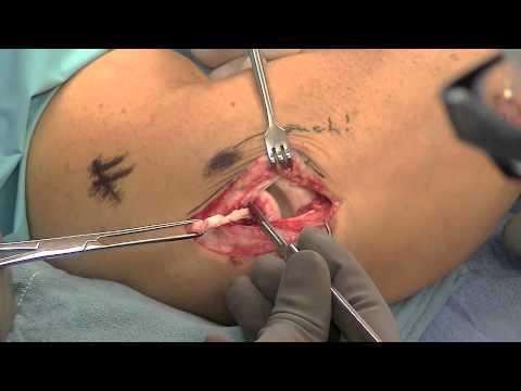 Operative treatment Nirschl release and