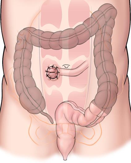 Crohn s Disease Laparoscopic and single-incision laparoscopic procedures for pediatric patients with IBD have been described