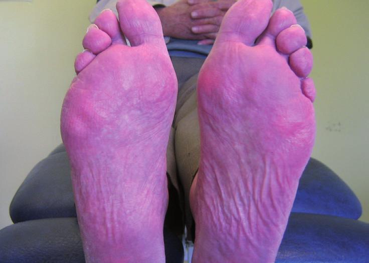 HOW CAN DIABETES AFFECT MY FEET? What is neuropathy? This leaflet explains how diabetes can affect your feet, what neuropathy is and how to keep your feet healthy.