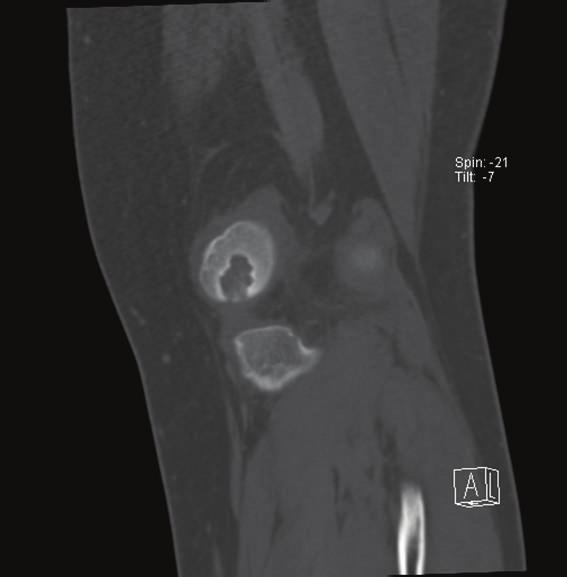 abutting the posterior articular surface with a 3 mm collapse of the subchondral bone and breach of the chondral surface (Figure 3).