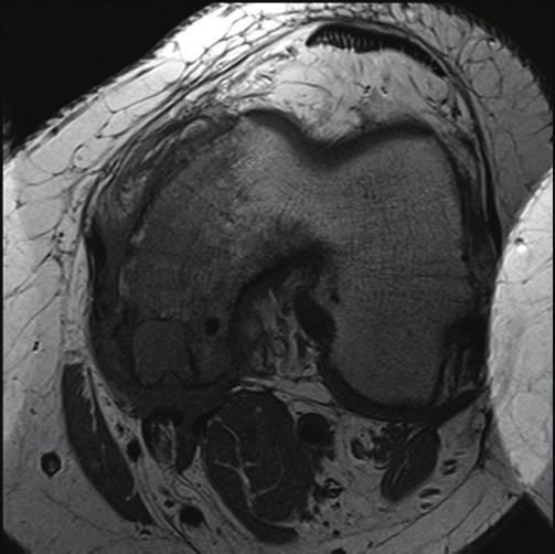 Case Reports in Orthopedics 3 Figure 3: T1 TSE axial and sagittal images and T1 TSE w/fs axial image showing a lytic lesion with sclerotic borders involving the posterior aspect of the medial femoral