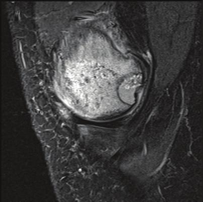 MRI and CT imaging of the left knee were obtained which demonstrated incorporation of the osteochondral allograft (Figures 7 and 8) and resolution of the previously associated medial condyle marrow