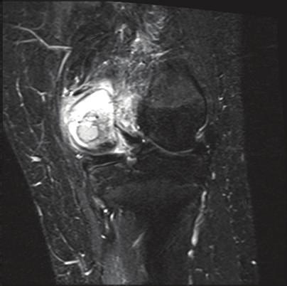 Discussion Chondroblastoma is a rare benign primary bone tumor commonly presenting in the knee of young patients [3, 5].