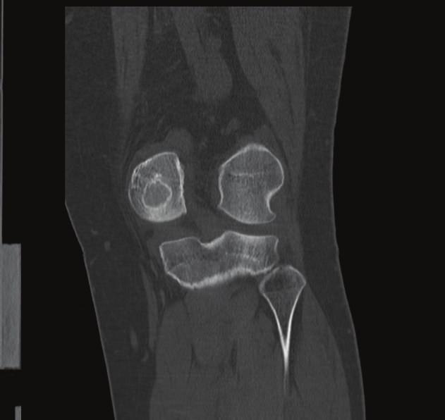 Given our experience with this case we feel that intralesional curettage with osteochondral allograft reconstruction is a viable surgical option for chondroblastomas involving the articular surface