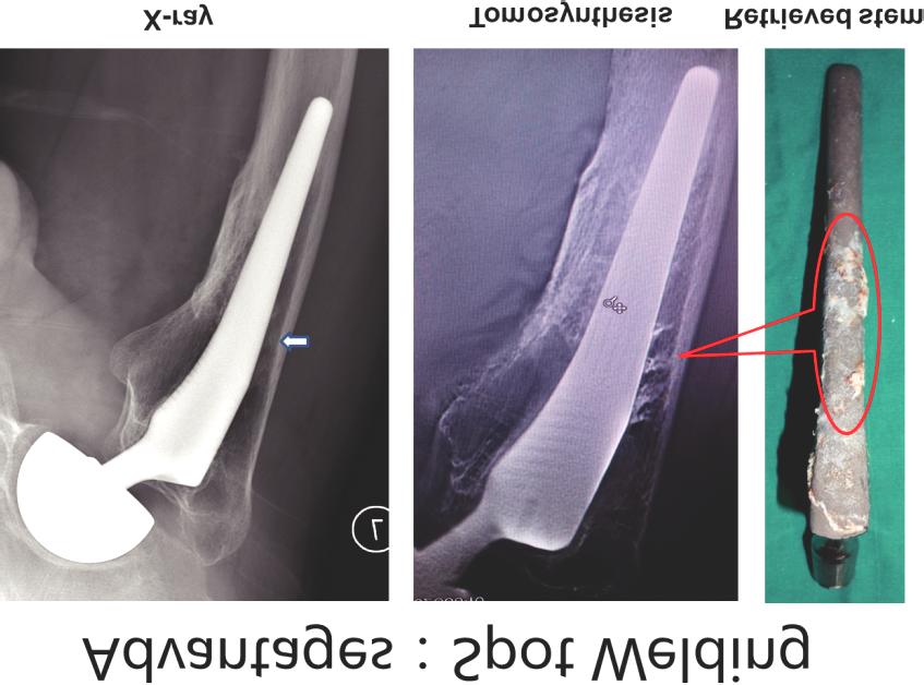 Basically, the philosophy of T-smart is to divide metal image and periprosthetic bone images separately.