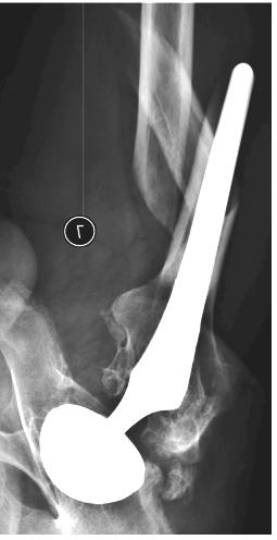 effectively guided us when disrupting the bone-prosthesis in-growth sites. 3.4. Case 4 (Fig.