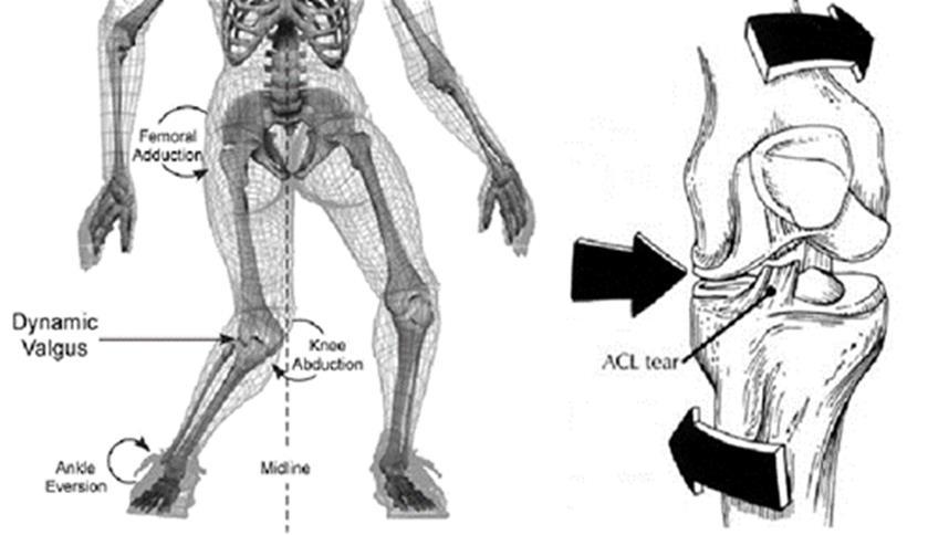 10 3.3 Mechanism of ACL injury ACL tear or rupture is a common knee injury amongst participants of competitive sports involving pivoting, side stepping or jump landing (Rodriguez-Merchan.