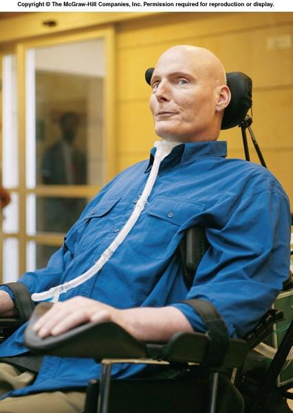 Christopher Reeve an American actor, best known for his motion picture portrayal of superhero Superman. Reeve became a quadriplegic after a severe spinal cord injury.