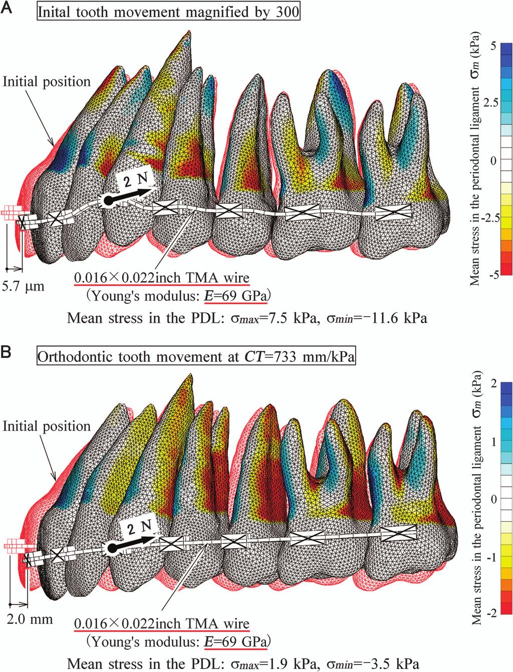 3 of 7 257 SIMULATIONOF OFORTHODONTIC ORTHODONTICTOOTH TOOTHMOVEMENT MOVEMENT SIMULATION a rigid power arm is bonded to the archwire.