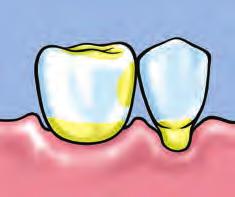 coating or barrier to protect at-risk tooth surfaces.