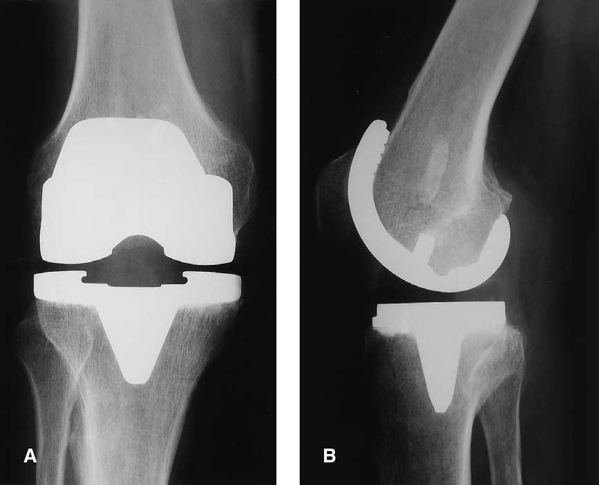 680 The Journal of Arthroplasty Vol. 19 No. 6 September 2004 Fig. 2. Postoperative (A) anteroposterior and (B) lateral radiographs at 5 years.