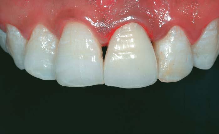 to natural dentin and enamel, so restorations are virtually undetectable.