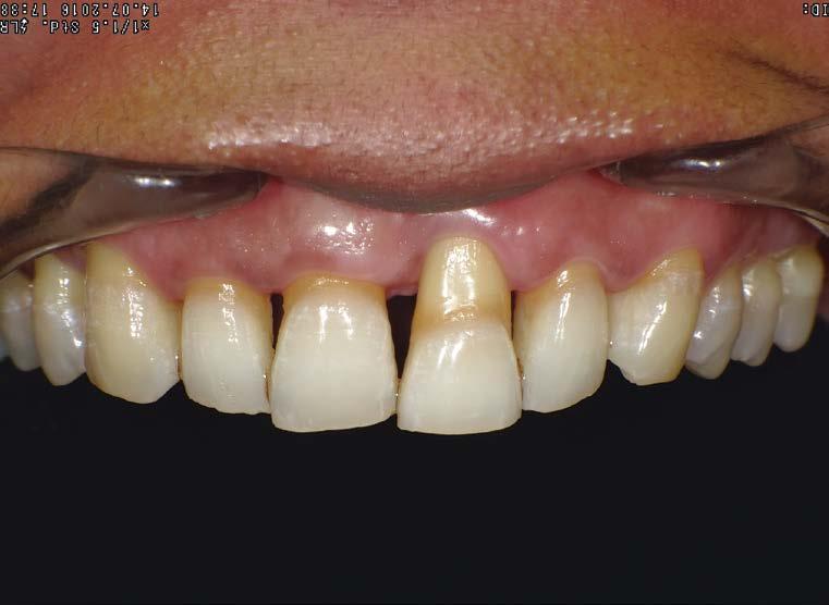 with severe gingival recession