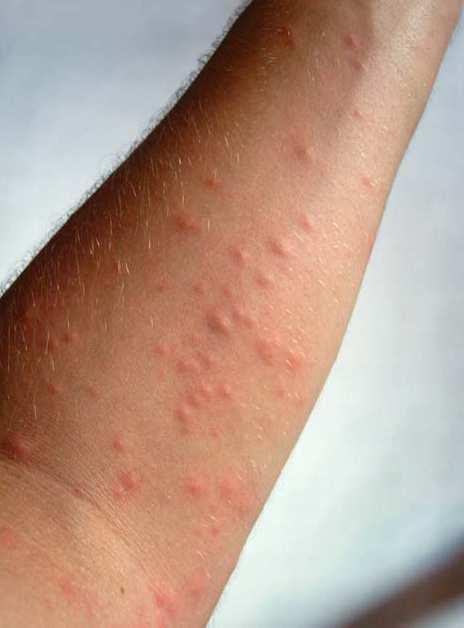 New airborne allergens Oak Processionary Moth Skin reaction strong itchiness contact urticaria