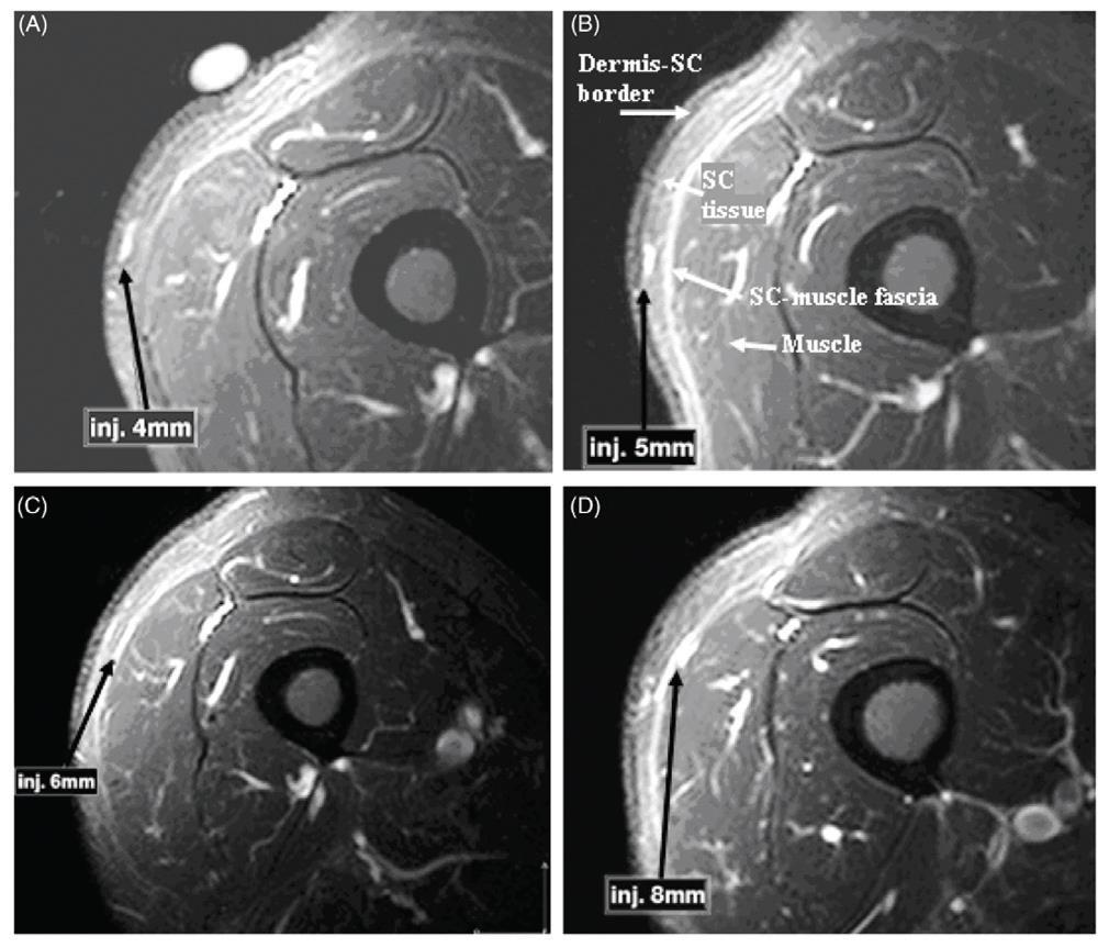 Needle length Gibney and colleagues recently published data about calculated injection tissue depth with 90 degree insertion