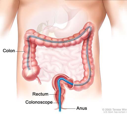 Colorectal cancer Major health problem in the western world Second leading cause of cancer death Most studied and