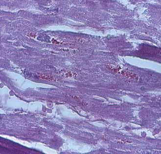 196 REVISTA ROMÂNÅ DE BOLI INFECºIOASE VOLUMUL XIV, NR. 4, AN 2011 Myocardial tuberculosis, Koch bacillus, is viewed histologically in 1 case (6.