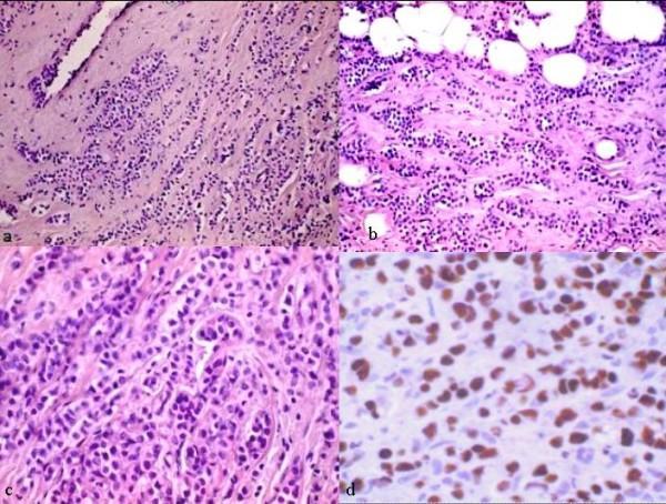 Recommendations lobular carcinoma Wider negative margins than no ink on tumor are not indicated for invasive lobular carcinoma