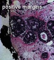 Recommendations positive margins A positive margin ink on invasive cancer or DCIS at least a two-fold increase in IBTR This increased risk in IBTR