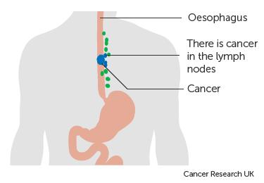 Oesophageal Cancer TNM NX N0 N1 N2 N3 Regional lymph node(s) cannot be assessed No regional lymph node metastasis