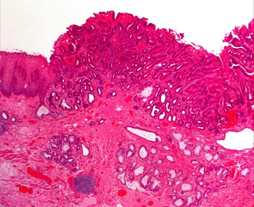 Entrapped and submucosal glands