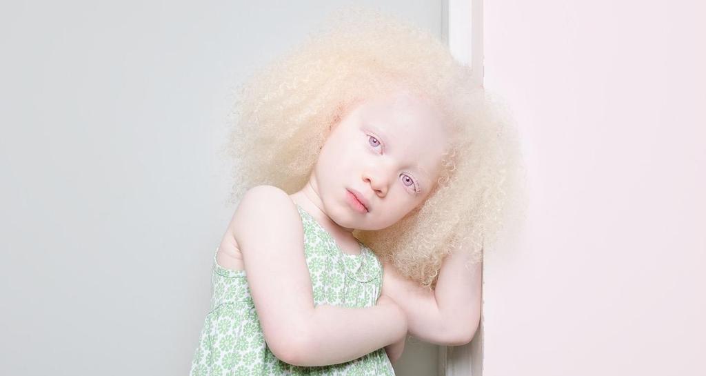 Clinical Application- Albinism Genetic disorder Caused by defective